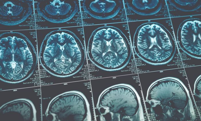 X-Ray images of human brains shown next to each other